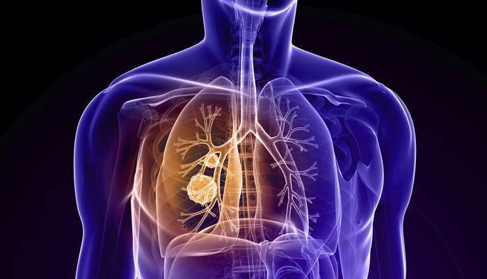 Doença Pulmonar Obstrutiva Crónica