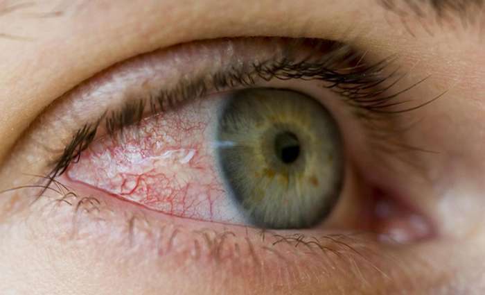 Alerta para aumento de problemas oculares no verão