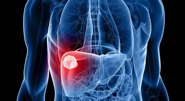 Médicos alertam para a prevenção do cancro do fígado